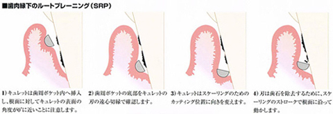 ルートプレーニング
